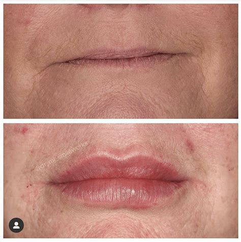 lip fillers liverpool breathtaking precision and 2023 prices