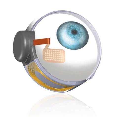 argus ii bionic eye implants   blind    read wired uk