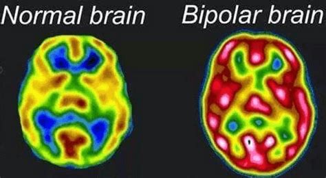 bipolar patients    abnormal brain matter amber usa