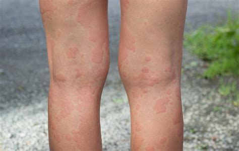 guide  recognizing  early signs  shingles