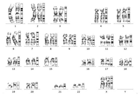 Karyotype Of 46 Xx Male Download Scientific Diagram