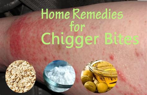 home remedies   rid  chigger bites