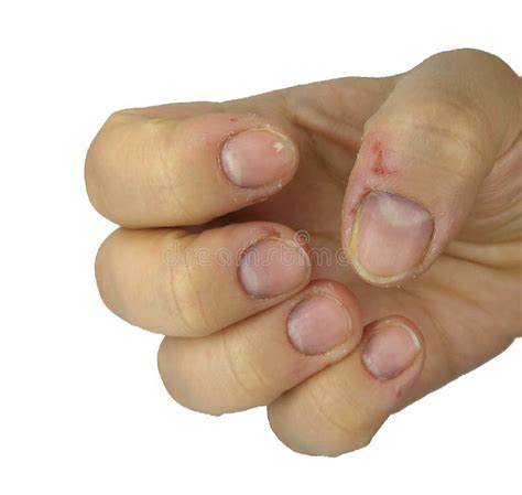 beschadigde spijkers die probleem na het doen van manicure hebben gezondheid en