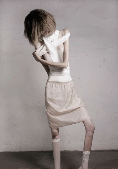 Thirty Two Kilos La Anorexia En 14 Imágenes Foto 13 De 14 F5