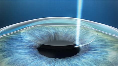 history  laser eye surgery envision eye centre