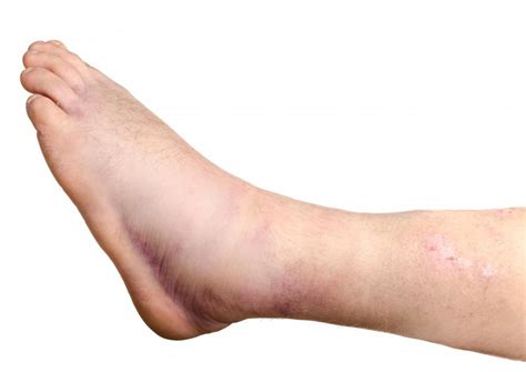 common   swelling   leg
