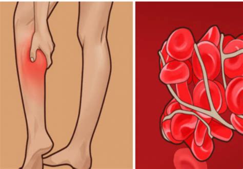 znate li kako prepoznati krvne ugruske ove simptome shvatite jako ozbiljno dvoklik