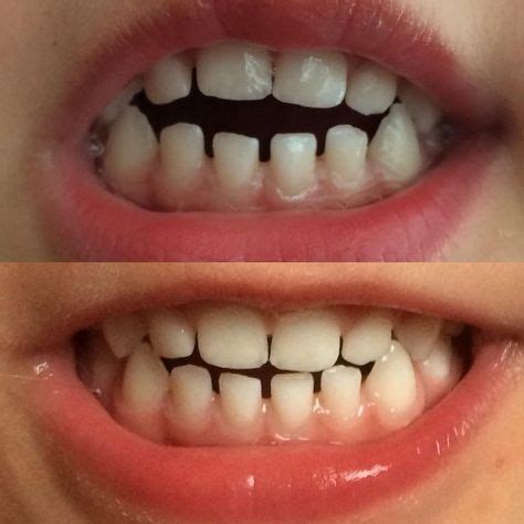 dummies  affect teeth teeth canning