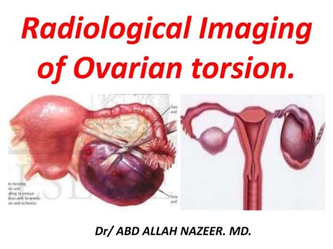 radiological imaging  ovarian torsion