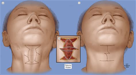 direct submentoplasty  neck rejuvenation jama facial plastic