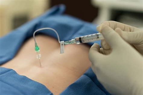 epidural steroid injections   expect core medical wellness