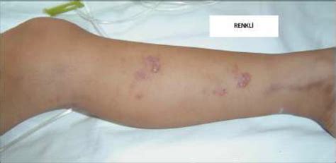 skin lesions   patient  scientific diagram
