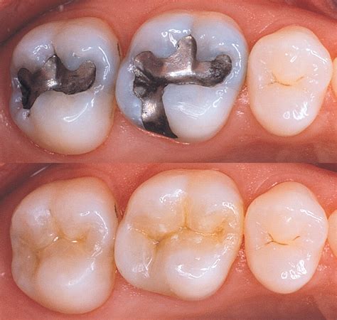 dental fillings    replaced pistuffing