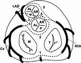 Coronary Artery Anomalies Anomalous Ahajournals Sudden Circulation sketch template