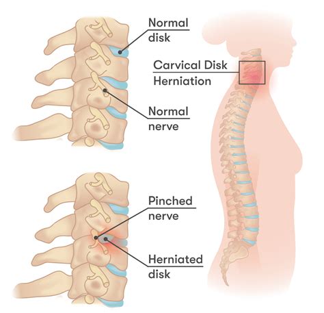 pinched shoulder blade nerve symptoms  pain relief