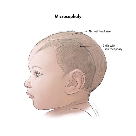 People With Microcephaly