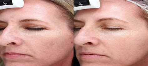 microneedling skinpen collagen induction therapy
