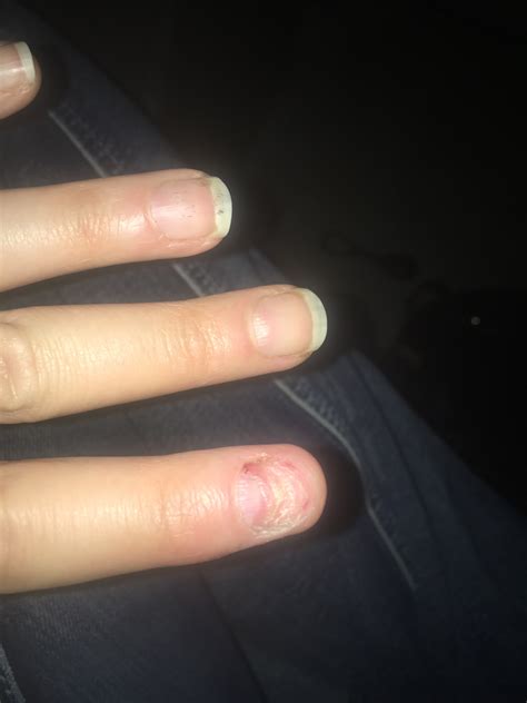 My Nail Came Off My Finger Best Nail Designs 2020