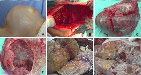 woman s 90 pound mucus filled tumor surgically removed live science
