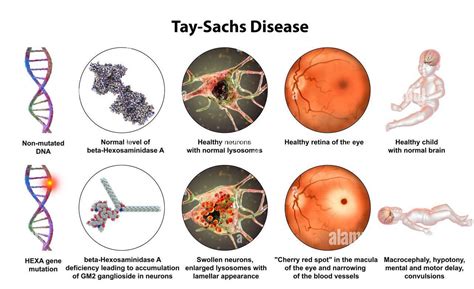 Tay Sachs Disease Medizzy