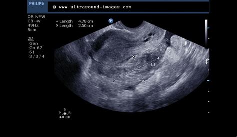 Cochinblogs Sonography Of Ectopic Pregnancy