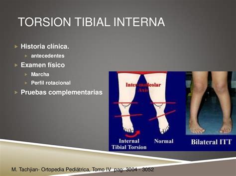 torsion tibial