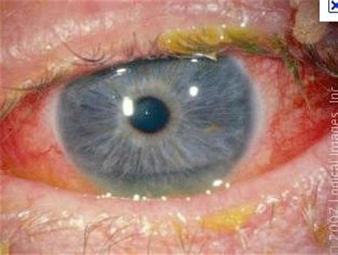 red eye  university   south wales studyblue