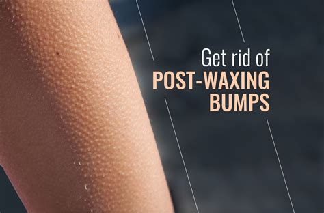 get rid of post waxing bumps