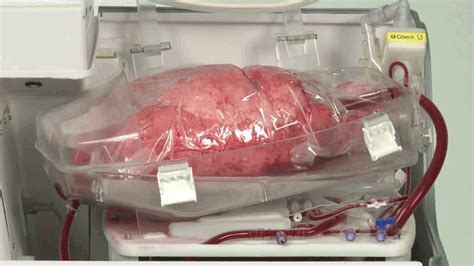 lung in a box keeps organs breathing before transplants shots health news npr