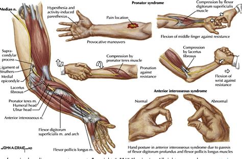 figure   diagnosis  treatment  work related proximal median  radial nerve
