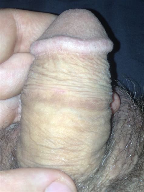 scarring on penis milf nude photo