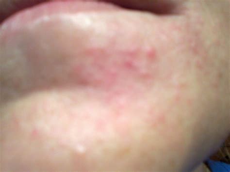 small blister type rash from corners of mouth down to chin