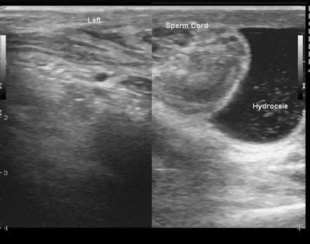 partial testicular torsion ultrasound