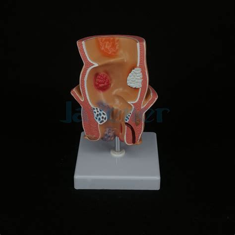 anatomical human rectum pathology lesion model hemorrhoids anus medical