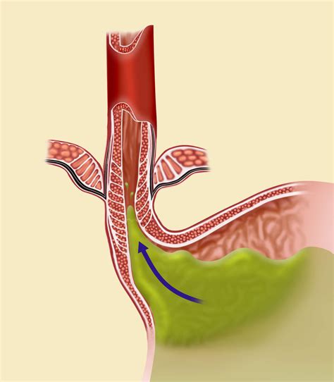 gastroesophageal reflux disease gerd minimally invasive  gastrointestinal surgery