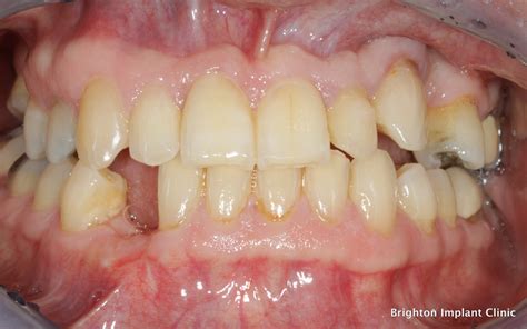 dental implant replacing problem canine tooth dental implants