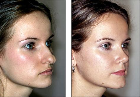 pictures show   nose job  change  face  pics