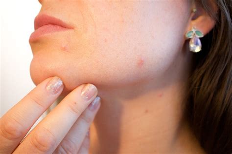 skin lesions  types     rid   beauty  glee