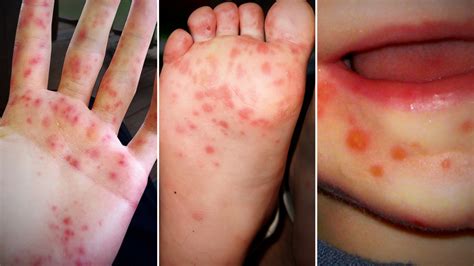 doctors see increase in hand foot and mouth disease wink news