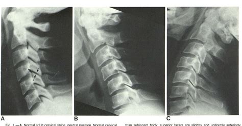 table 1 from anterior subluxation of the cervical spine hyperflexion