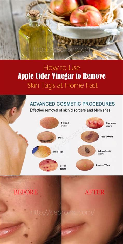 how to use apple cider vinegar to remove skin tags at home fast apple