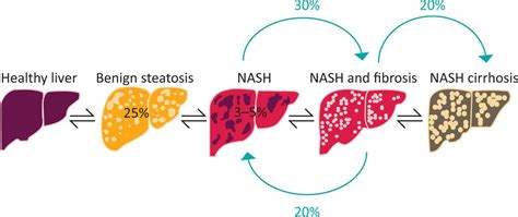 non alcoholic fatty liver disease rcp journals