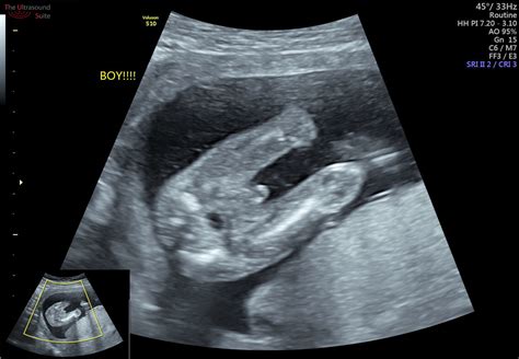 early   find   babys gender  ultrasound suitethe ultrasound suite