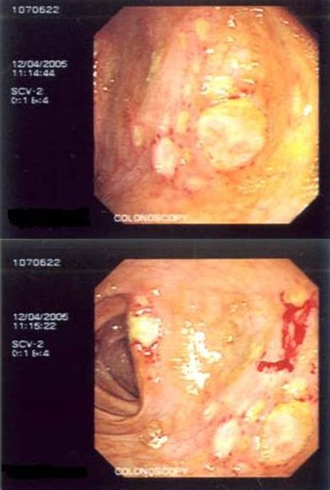 Pictures sexually transmitted desease