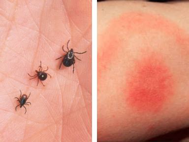 lyme disease   signs conservation federation  missouri
