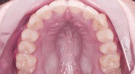 orthodontics treatment hatala orthodontics pc orthodontist