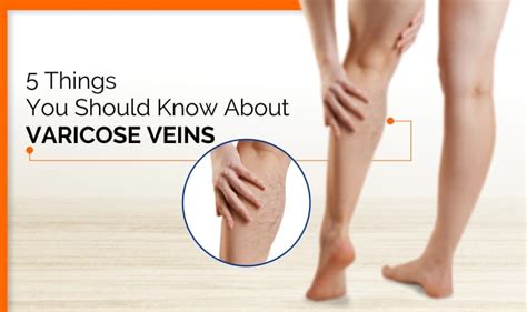 5 Things You Should Know About Varicose Veins Blog On Healthcare