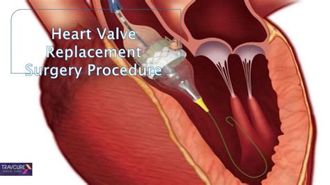 Heart Valve Replacement Surgery Procedure