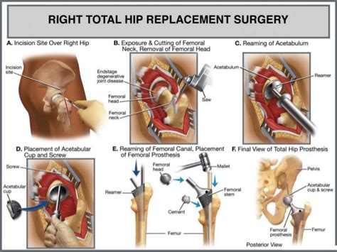 Total Hip Replacement In India