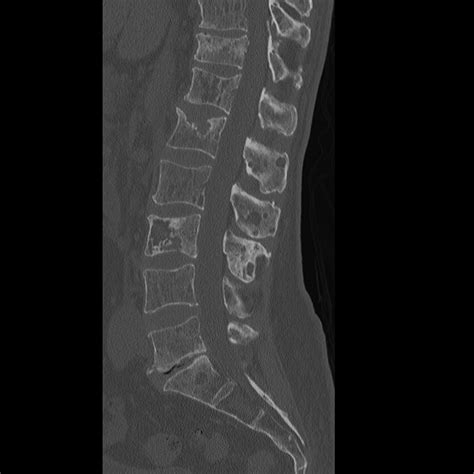 multiple myeloma skeletal survey image radiopaediaorg